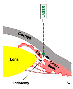 Laser Treatment of Angle-closure (iridotomy